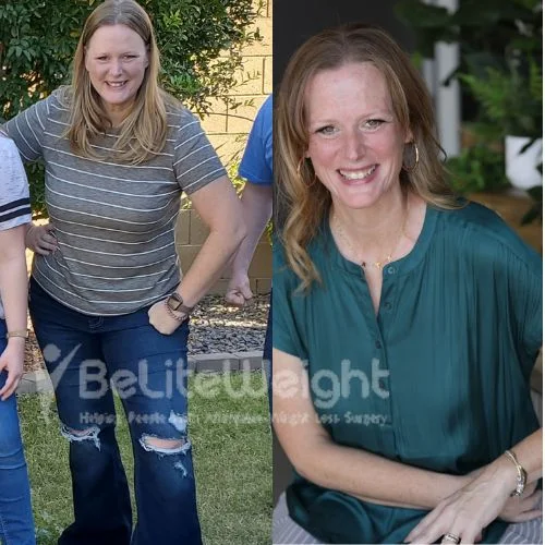 Cadí H - mini gastric bypass - 3 years update*